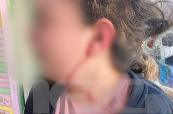 Επίθεση σκύλου σε 10χρονη στη Σκύδρα