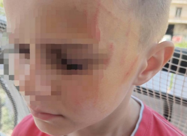 5χρονος μαθητής στο Αγρίνιο ξυλοκοπήθηκε από συμμαθητές του