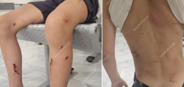 Επίθεση αδέσποτων σκύλων σε 7χρονο στον Βόλο