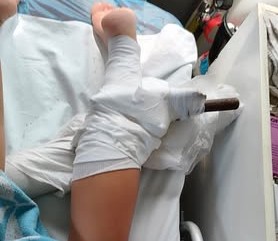 Κομμάτι ομπρέλας σε πόδι λουόμενης