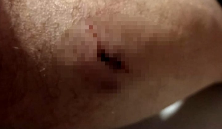 Σκύλος επιτέθηκε σε πολίτη στη Θεσσαλονίκη