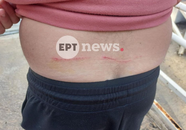 Περιπατητής δέχθηκε επίθεση από λύκο